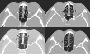 Number Of The Ethmoid Air Cell Septa In Branching Shapes Black Download Scientific Diagram
