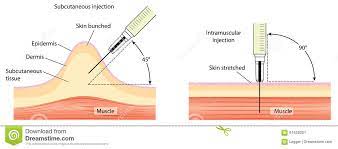Subcutaneous And Intramuscular Injection Techniques Stock Vector Illustration Of Science Medicine 61658201