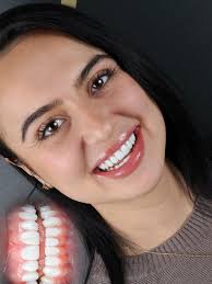 We all have to smile .but, why not smile beautiful 💫You can have a perfect  smile ,just in perfect Smile Clinic in Istanbul,turkey. Enjoy professional  before and after of this case that