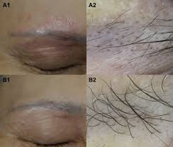 The hair follicle is an organ found in mammalian skin. The Dermoscopic Comma Zigzag And Bar Code Like Hairs Markers Of Fungal Infection Of The Hair Follicles Sciencedirect