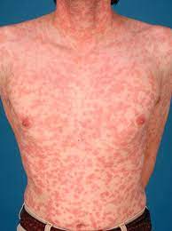 We did not find results for: Syfilis Syphilis Lues Patientenfolder