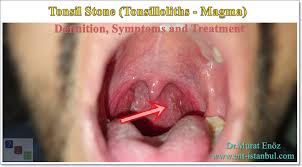 When not mineralized, the presence of debris is known as chronic caseous tonsillitis (cct). Tonsil Stone Definition Symptoms And Treatment