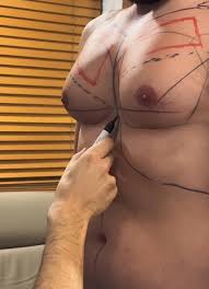 Ginecomastia: saiba o que é, os tratamentos e como afeta a saúde mental  masculina | Saúde | gshow