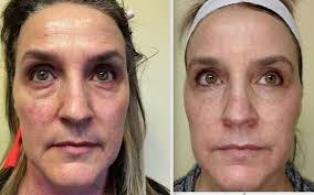 CoolSculpting by Revival Med Spa in Flagstaff, AZ