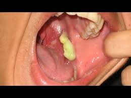 Other home remedies include gargling. Tonsil Stones What Are They Tonsilloliths Youtube