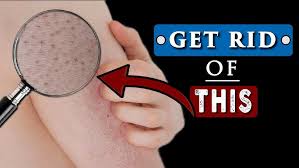 A doctor may also recommend creams or lotions to help with moisturizing the skin. How To Get Rid Of White Bumps On Arms Keratosis Pilaris Youtube