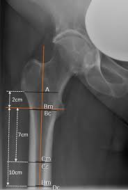 Image result for Hip XRay