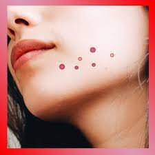 Acne get rid, acne how to get rid of, get rid acne, get rid of acne, get rid of pimples. Best Acne Treatment For Every Type Of Acne Glamour
