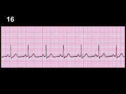This quiz includes ecgs recorded at 25 mm/s and 50 mm/s. Ecg Rhythm Recognition Practice Test 1 Youtube