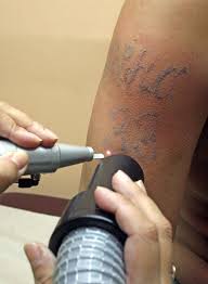 Pharrell williams isn t happy with his tattoos celebrity tattoo. Regret That Tat Try Skin Grafting Tattoos Health Bet
