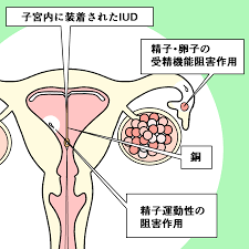 避妊リングとミレーナ | ジャスミンレディースクリニック渋谷・新宿・池袋・東京