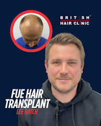 Who doesn't want to feel younger? Lee Hatch said it best — 'I feel so much  younger!' after his hair restoration. ✨ Ready to feel the same? Book your  free consultation today.