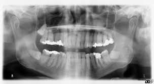 But actually understanding what you are looking for in the. Dental Radiography Wikipedia