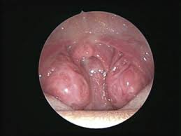 Image result for tonsilla palatina