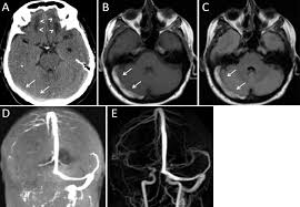 See that article for a discussion of that specific clinical entity. Current Endovascular Strategies For Cerebral Venous Thrombosis Report Of The Snis Standards And Guidelines Committee Journal Of Neurointerventional Surgery