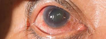 A number of types of glaucoma surgeries may be used in people who do not respond sufficiently to other measures. Glaucoma Treatment Ophthalmologist In San Diego Ca Anderson Family Ophthalmology