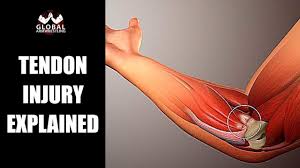Tendons are the connective tissues that connect muscle to bone. Tendinopathy And Tendonitis What It Is And Why Does It Occur Youtube