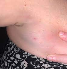 Pluck out the nipple hair this technique involves using a strong pair of tweezers. Pimple Ingrown Hair 3rd Nipple Help Hot Topics Forums What To Expect