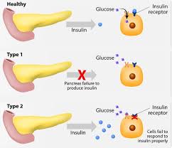 Diabetes Mellitus Subtypes