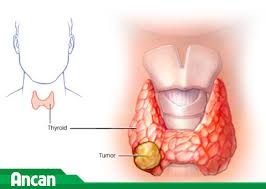 0961656028) bị cường giáp đã 4 năm. Ung ThÆ° Tuyáº¿n Giap Thá»ƒ Tá»§y