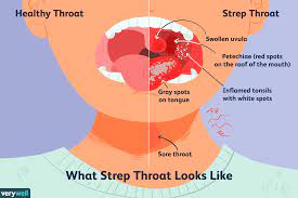 What Is Strep Throat Overview And More