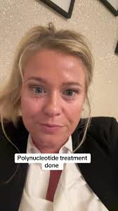 Experience Polynucleotide Treatment for Aesthetic Beauty