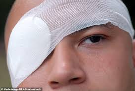 The first treatment for blepharitis is placing a warm compress on the affected eyelid several times a day. Dr Ellie Cannnon Op To Fix My Droopy Eyelid Has Left Me Looking Worse Daily Mail Online