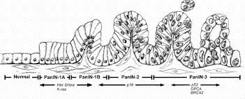Pancreatic cancer begins in the tissues of the pancreas, which is an organ in the abdomen that releases enzymes that aid digestion and hormones that manage blood sugar. Infocancer Arcagy Gineco Localisations Appareil Digestif Cancer Du Pancreas Formes De La Maladie Les Tumeurs Non Endoctriniennes