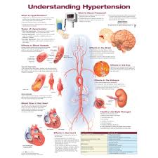 Understanding Hypertension Chart Poster Laminated