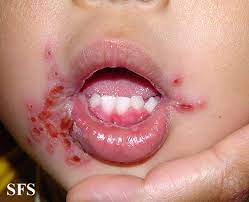 Cold sores are caused by herpes simplex type 1 (hsv 1) more often than herpes simplex type 2 (hsv 2). Herpetic Gingivostomatitis Wikidoc