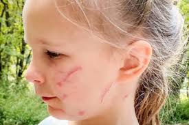 Fundraiser for MaryWells Smith by Rachel Flemming : Meredith Smith's  Medical Expenses (Dog Attack)