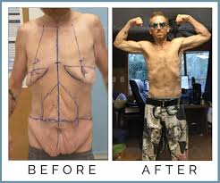 Breast augmentation, tummy tuck, face lift and many more other procedures. Body Lift Orlando Florida Remove Excess Skin Celebrities Choice Cosmetic Surgery Dr Trevisani