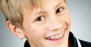 Aparelho Dental Infantil Tudo O Que Voce Precisa Saber Vs Ortodontia