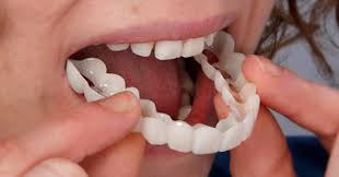 A dental veneer is a thin layer of material, usually porcelain or resin enamel dental studio offers high quality dental veneers to clients across brisbane and logan areas. Why You Might Want To Think Twice About Snap On Teeth And What To Do Instead Banker Dental Associates