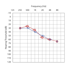 How to read your hearing test or audiogram? Air Conduction Vs Bone Conduction Candidacy Guide For Bone Conduction Systems Med El Professionals Blog