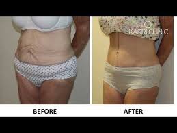 Jeffrey claiborne of northshore plastic surgery in. Fleur De Lis Surgery Download Lyrics Mp3 And Mp4 Fusion Sketch