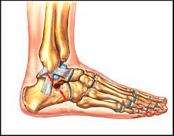 Sinus Tarsi Syndrome Footeducation