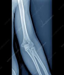 Image result for Elbow XRay