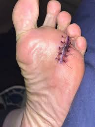 Bunion surgery screw causing foot pain after 25 years