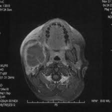 Research has revealed a high incidence of accompanying tumors (specifically chondroblastoma and giant cell tumors) in 23 to 32 percent of patients with an aneurysmal bone cyst. Osteolytic Process Of The Mandible Aneurismal Bone Cyst Eurorad