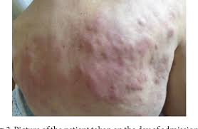 It preferentially affects the elderly and carries a poor prognosis, with a median survival of less than three years (15). Pdf Angioimmunoblastic T Cell Lymphoma Mimicking Chronic Urticaria Semantic Scholar