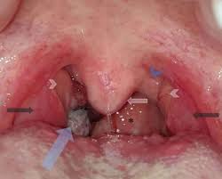 Pictures of infected throat after tonsillectomy. A Bleeding Throat Emergency Medicine Journal