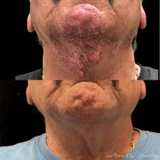 Image result for Vitiligo