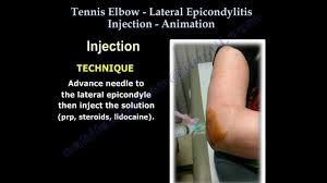 Image result for Elbow Joint Injection