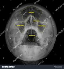 Image result for Sinus X Ray