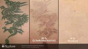 To learn more about safe and effective tattoo removal with revlite, contact sky and sea spa today. 1 Miami Laser Tattoo Removal Spa Picosure Laser