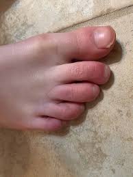 Image result for Chilblains