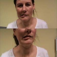 Functional facial spasm/dystonia is characterised by contraction of...