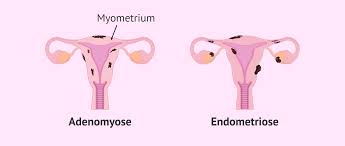 Die adenomyose in der gebärmutter verursachte dass ich jeden monat ohnmachtsanfälle und kreislaufprobleme hatte. Uterus Mit Adenomyose Und Uterus Mit Endometriose