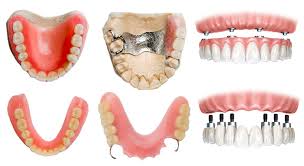 Dentures Cost Full Partial Fixed Removable Insurance False Teeth